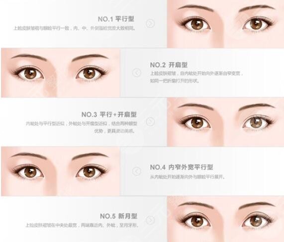 眼睑凹陷矫正术怎么样 眼睑凹陷矫正术前后对比图