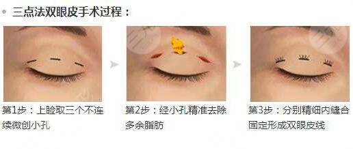 眼睑凹陷矫正术怎么样 眼睑凹陷矫正术前后对比图