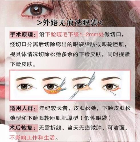激光,去眼袋,恢复