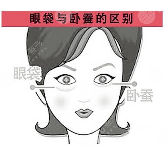 去眼袋,手术,卧蚕