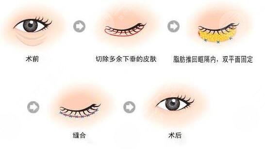 怎么样快速有缓解严重的眼袋和黑眼圈 去除黑眼圈和眼袋的喜欢办法