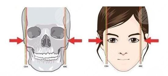 面部整形颧骨缩小手术成好吗?