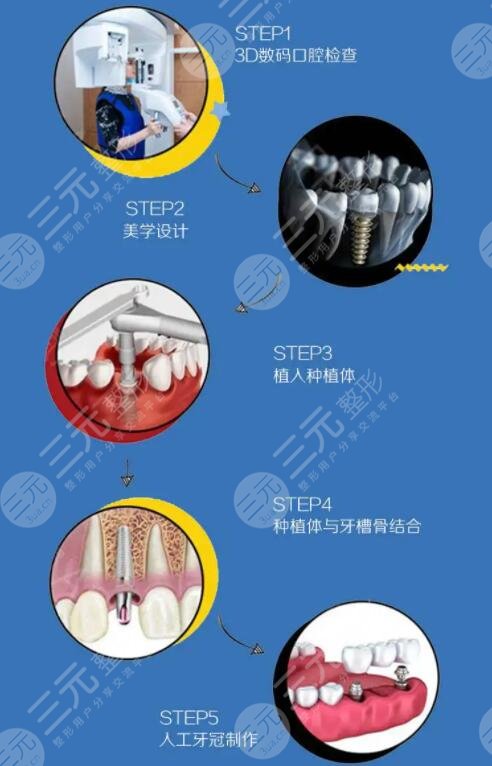 种植牙项目科普简介