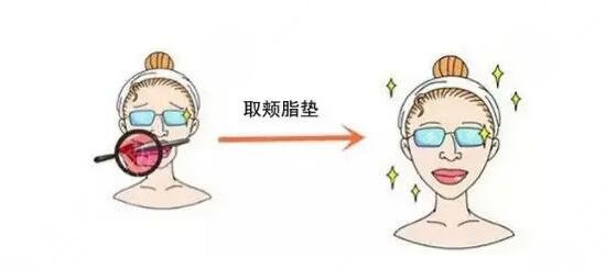 去颊脂垫|面部轮廓整形美容项目价格分享