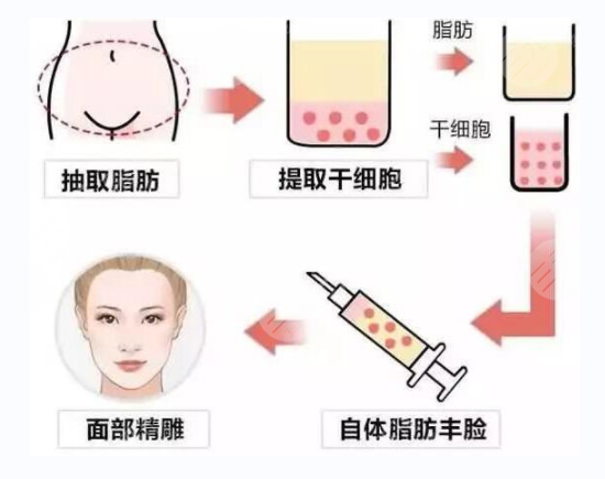 自体脂肪移植的果如何 对于脸颊问题的具体运用