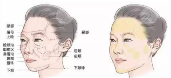 自体脂肪移植的果如何 对于脸颊问题的具体运用