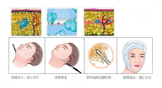 面部吸脂后遗症有哪些？