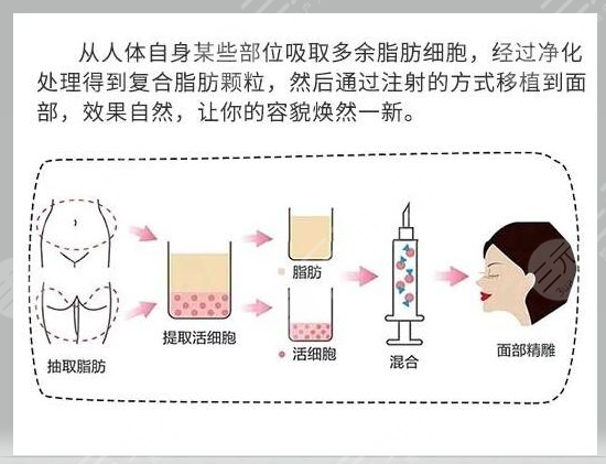 自体脂肪填充面部有风险吗？怎样避免风险？