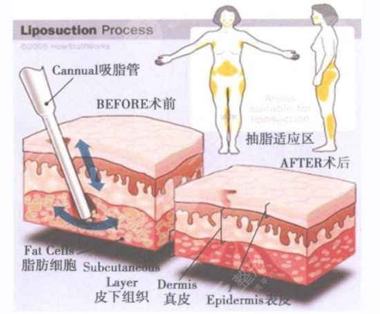 详细部自体脂肪填充果：美图放送~