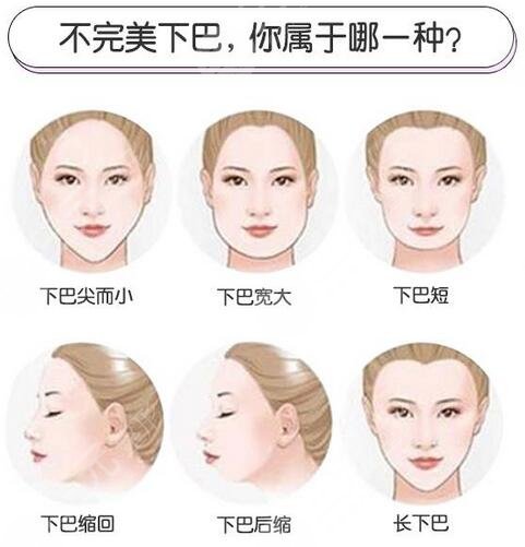 吸脂去双眼皮15天