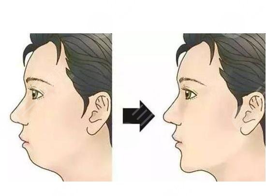 垫下巴多久消肿?怎样加快消肿?