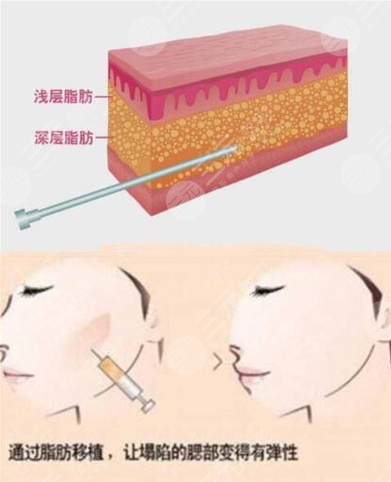 自体脂肪填充泪沟降低吸收率