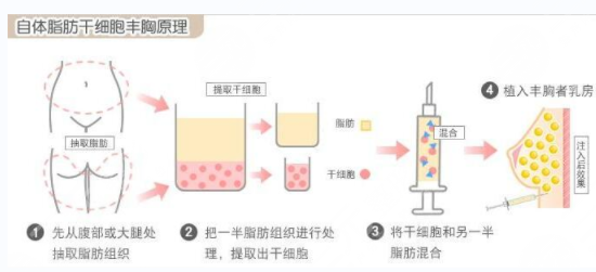 眼窝凹陷怎么办