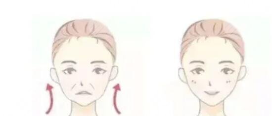 面部轮廓提升针是什么原理？多久才有果?