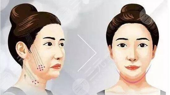 面部轮廓提升针是用什么打的？恢复期要多久?