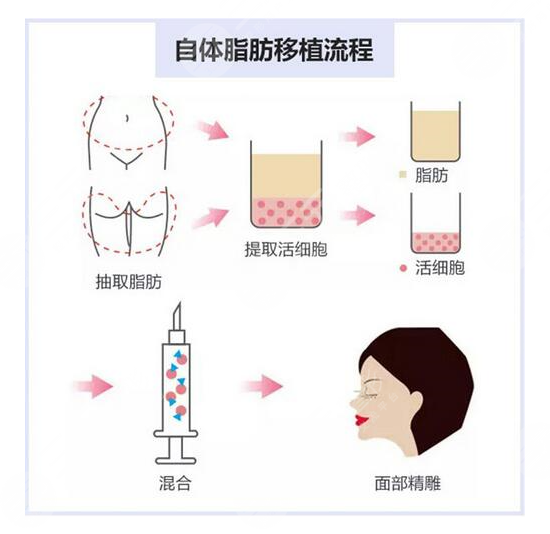 脂肪填充多久才算存活下来？面部填充经历分享