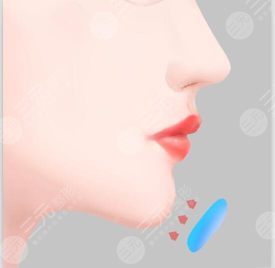 脂肪隆下巴怎么样？成好吗？多少钱，来瞅瞅！