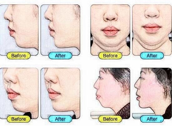 垫下巴价格是多少?价格收费详情