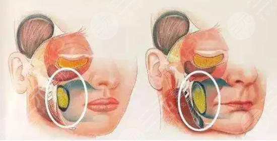 去除颊脂垫果的比较