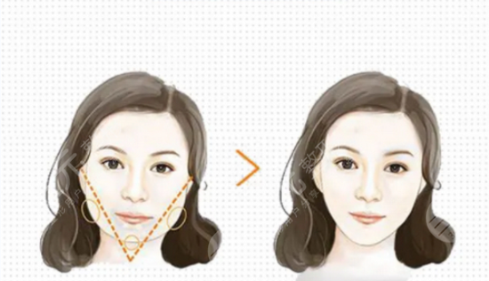 圆脸怎样变瓜子脸