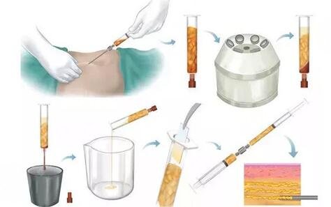 北京悦然医院李京霖吸脂的果好吗?