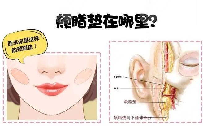 颊脂垫位置图分解图，取了就瞬间变瓜子脸？真有这么神奇？