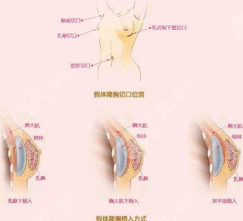 英国娜高假体都有哪些优势?