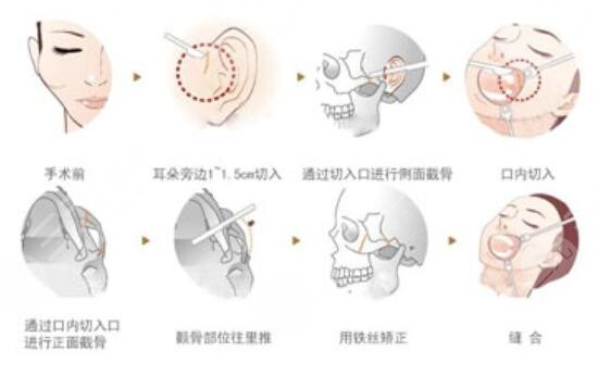 方形脸和国字脸的区别