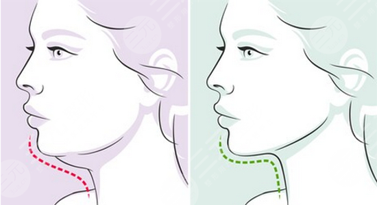 如何减去双下巴