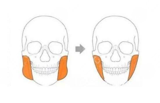 磨骨手术后的注意事项