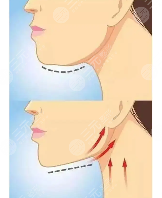 下颌线提升能够维持多久？4个大原因影响了果维持时间，都有哪些？