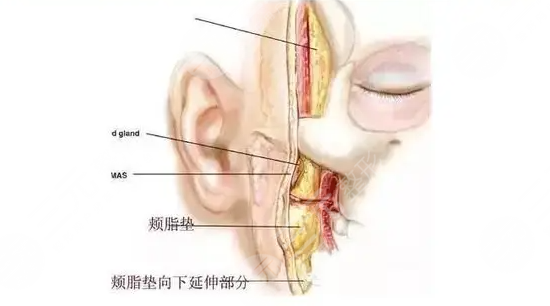 去颊脂垫
