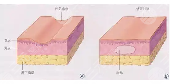 脸部自体脂肪填充价格