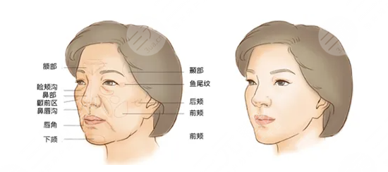 面部填充