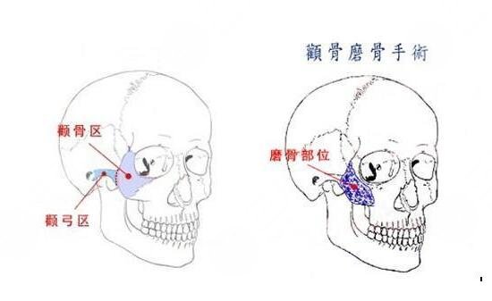 颧弓降低会下垂吗？颧弓降低手术的操作原理及理想果怎么样？