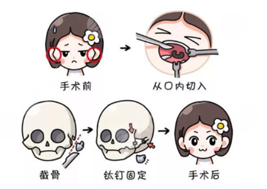 颧骨磨骨手术有后遗症吗