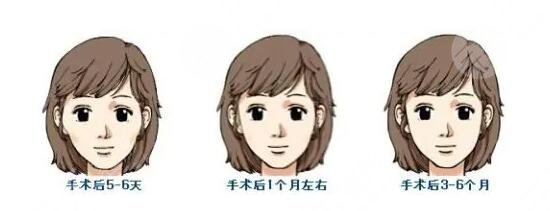 颧弓降低如何操作