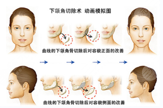 什么是磨骨手术