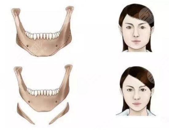 V-LINE瓜子脸手术和下颚角整形的区别，原理及果的区别【科普篇】