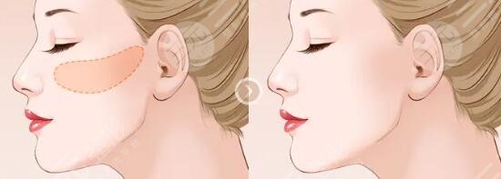去颊脂垫恢复时间长吗？手术科普+注意事项超全讲解！