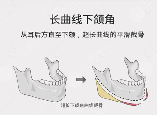 上下颌前凸矫正术需注意