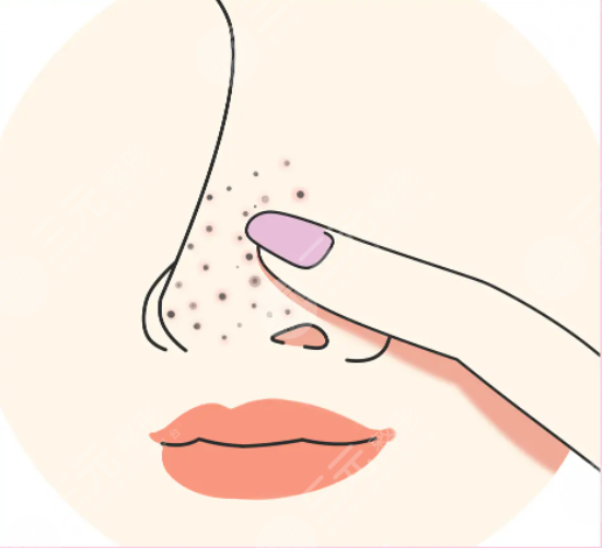 快速祛黑头的方法有哪些