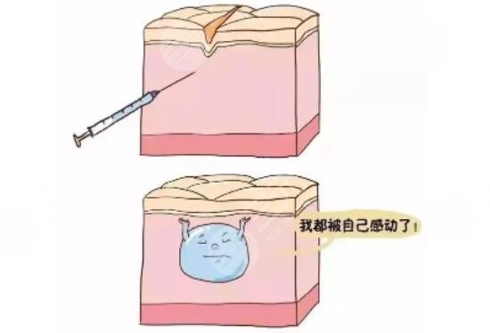 自己可以注射玻尿酸吗 为什么不能自己注射玻尿酸
