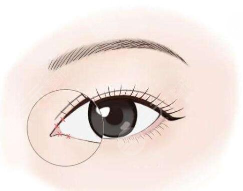 开眼角
