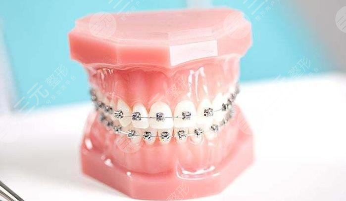 矫正牙齿治疗案例