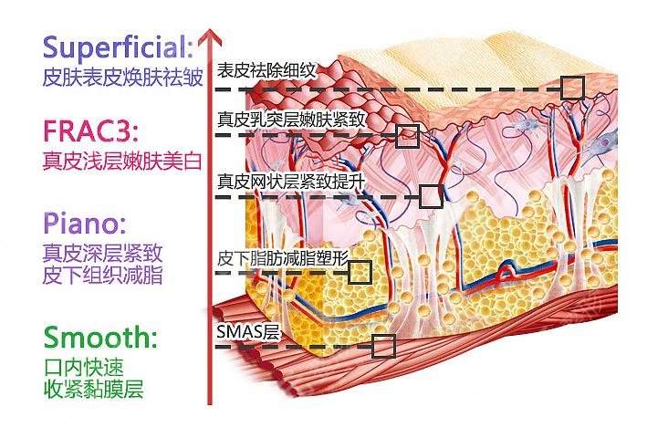 fotona4D和热玛吉的区别|哪个果好?