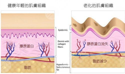 嗨体除皱一次可以保持多久?