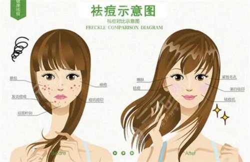 彩光祛痘的价格