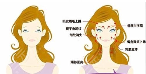 拉皮手术多大年龄做合适?30+、40+、50+该如何选择! 拉皮手术多大年龄做合适?30+、40+、50+该如何选择!