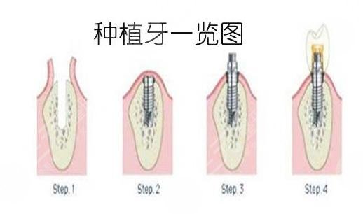 种植牙手术项目案例